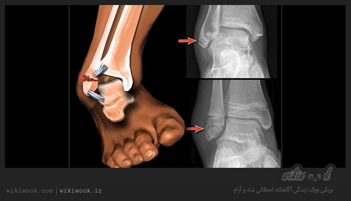 فیزیوتراپی در پیچ‌خوردگی مچ پا